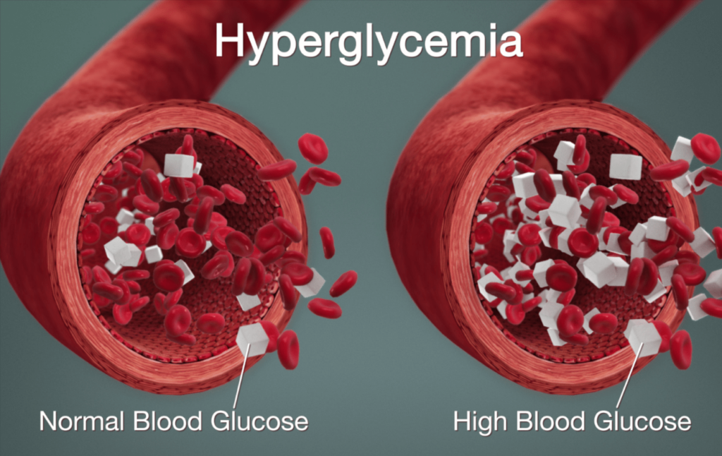 Hyperglycemia