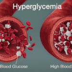 Hyperglycemia