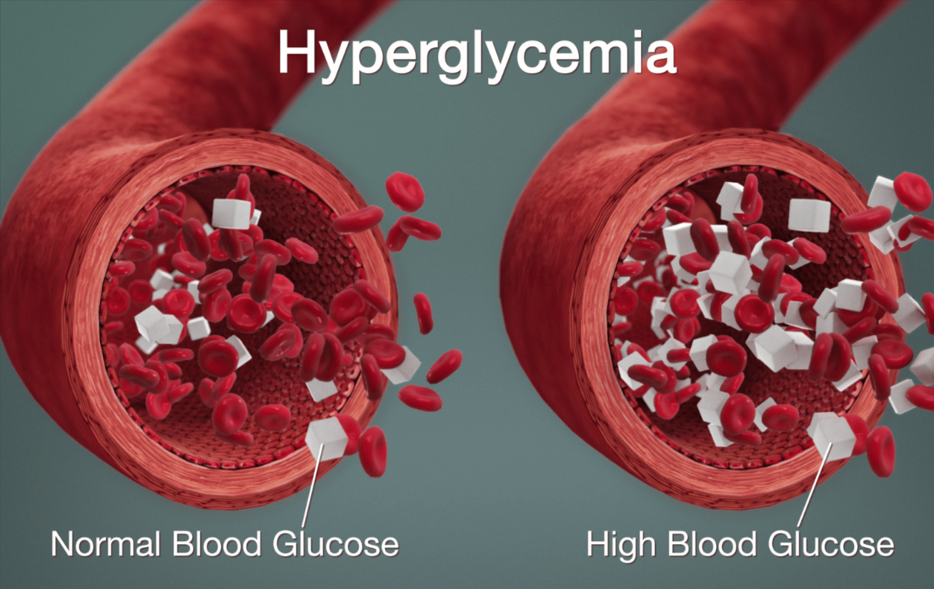 Hyperglycemia